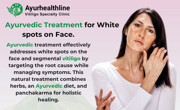 Vitiligo Remedy by Ayurhealthline Remedies Pvt Ltd
