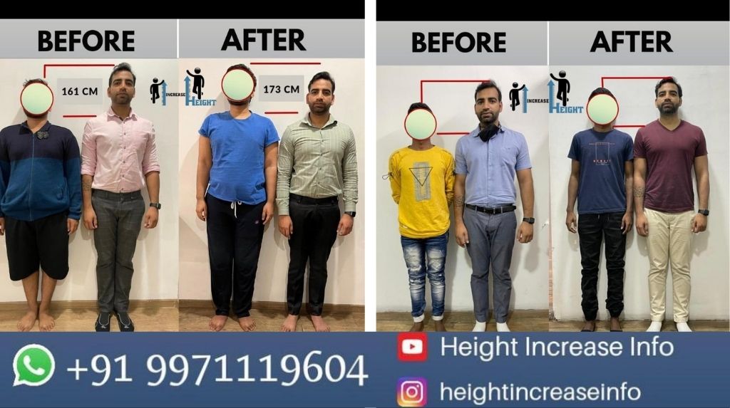 Navigating the Height: Limb Lengthening Surgery Costs in India (2025)
