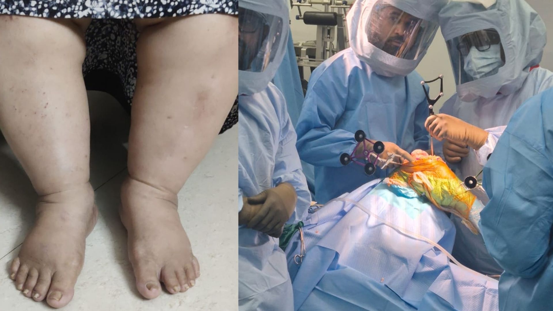 From 140 KGs and Years of Knee Pain to Walking Freely: Dr. Saikat Jena Restores a Woman’s Life with Surgery